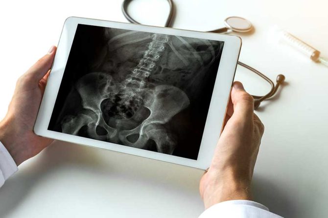 Vertebroplastia – O que é? – Osteoporose Vertebroplastia – O que é? – Osteoporose