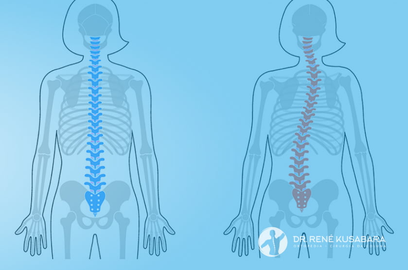 musculação #escoliose #escoliosis #coluna #colunavertebral