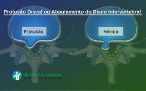 Protusão Discal ou Abaulamento do Disco Intervertebral Protusão Discal