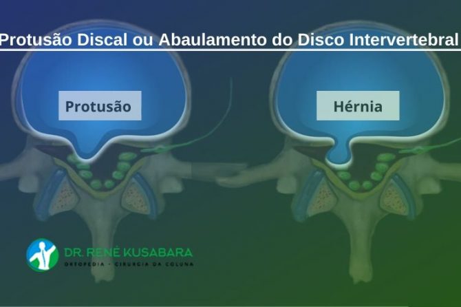 Protusão Discal ou Abaulamento do Disco Intervertebral