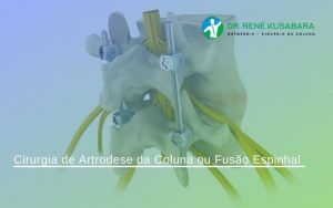 Cirurgia de Artrodese da Coluna ou Fusão Espinhal Cirurgia de Artrodese da Coluna ou Fusão Espinhal
