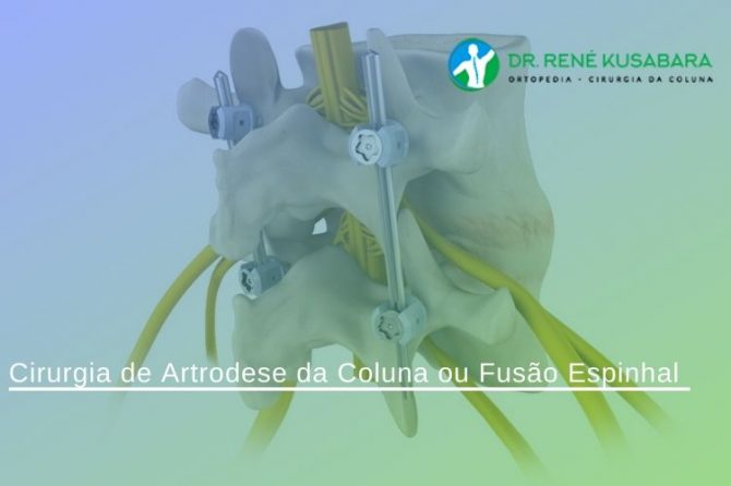 Cirurgia de Artrodese da Coluna ou Fusão Espinhal Cirurgia de Artrodese da Coluna ou Fusão Espinhal