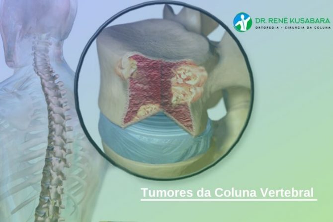 Tumores da Coluna Vertebral - Sintomas e Tratamento