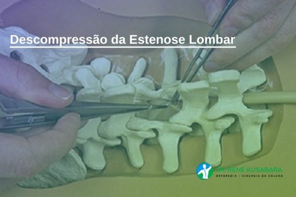 Descompressão da Estenose Lombar