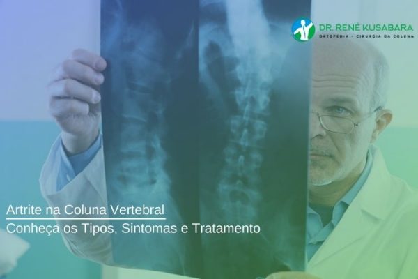 Artrite na Coluna Vertebral – Conheça os Tipos, Sintomas e Tratamento