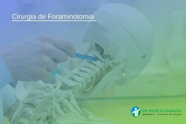 Cirurgia de Foraminotomia – Saiba Mais