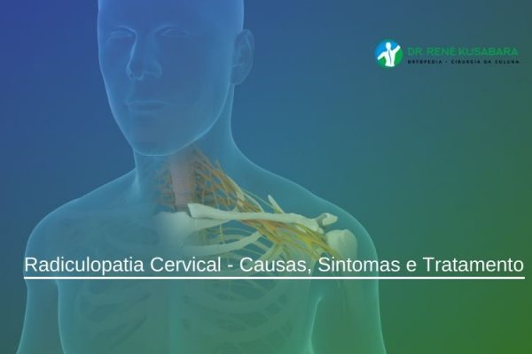 Radiculopatia Cervical – Causas, Sintomas e Tratamento