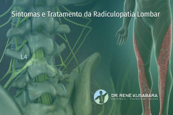 Sintomas e Tratamento da Radiculopatia Lombar Sintomas e Tratamento da Radiculopatia Lombar