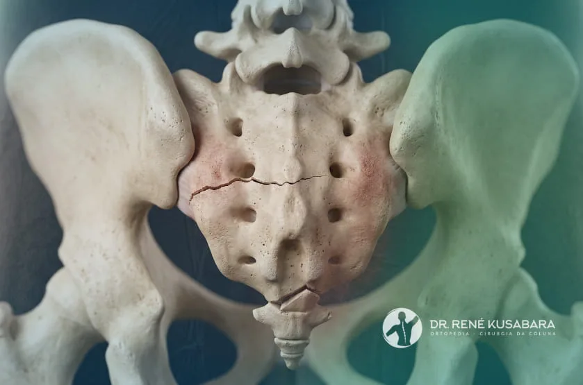 Fraturas do Sacro e Cóccix