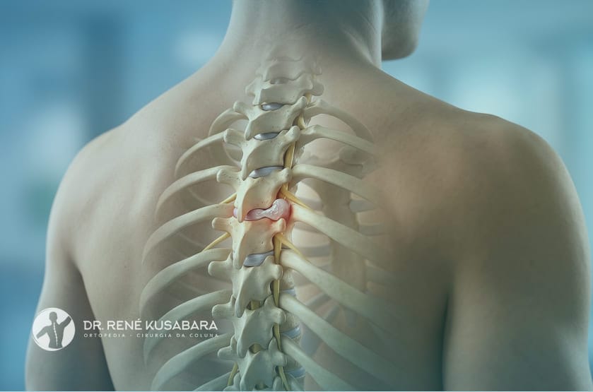 Hérnia de Disco Torácica