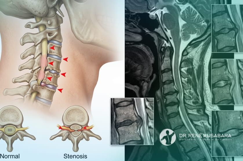 estenose espinhal cervical
