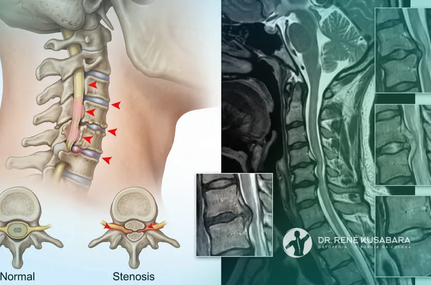 estenose espinhal cervical