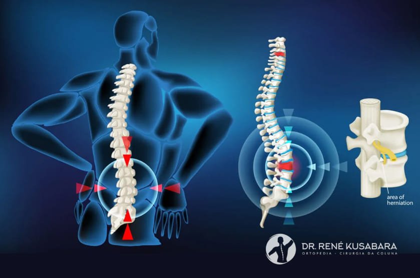 Hérnia De Disco: O Que É, O Que Causa E Quais Os Tratamentos