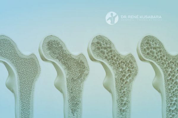 Estágios da Osteoporose – Compreenda a Evolução da Perda Óssea