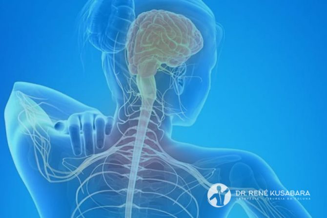 Nervo Comprimido no Pescoço – Causas, Sintomas e Tratamento
