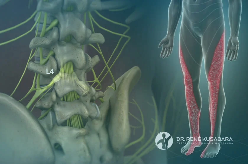 Radiculopatia Lombar