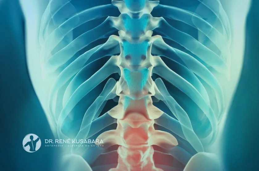 Protusão Discal