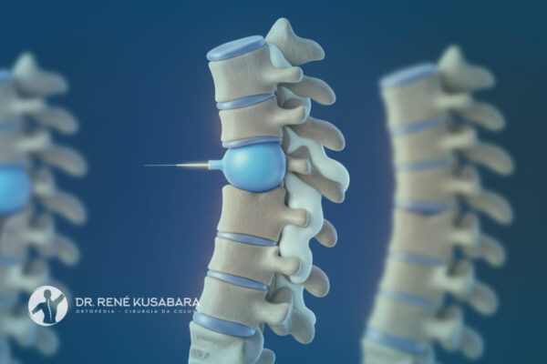 Cifoplastia – Quando é Indicada para Tratamento das Fraturas Vertebrais