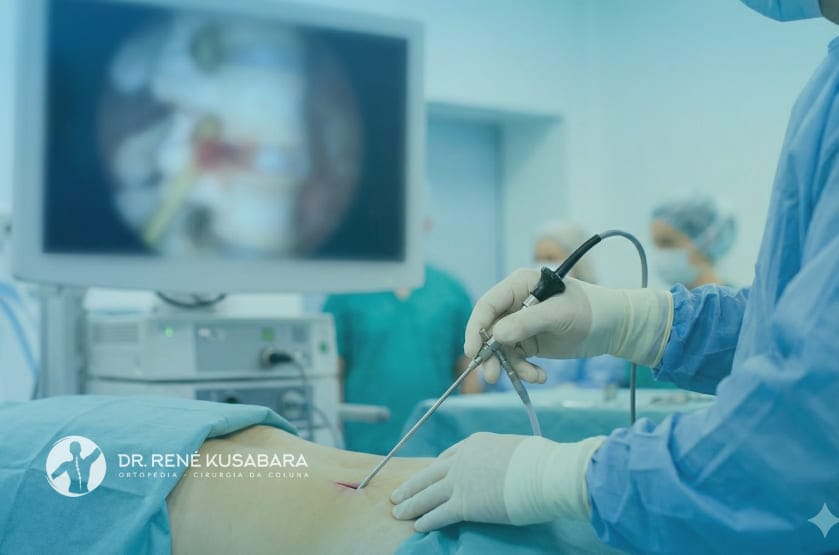 Endoscopia de Coluna em Fraturas por Compressão